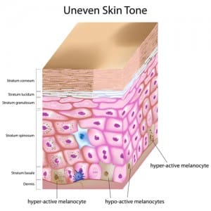 Post-inflammatory Hyperpigmentation