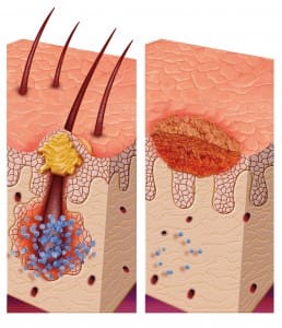 Once a sore has formed the hair follicle may be damaged and hair falls out. Once a scar is formed, hair will usually not grow again and hair loss will be permanent, called scarring alopecia.