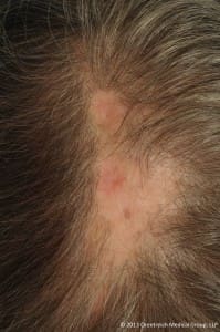inflamed, causing hair loss