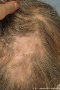 permanent scars & hair loss