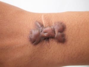 Keloid scar