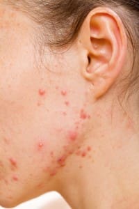 Sick and tired of acne? Try Isotretinoin
