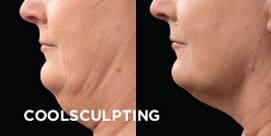 Coolsculpting