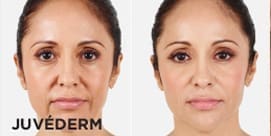 Juvederm