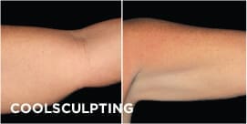 Coolsculpting