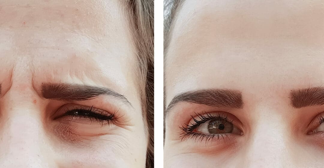 Botox®: What is it and how does it work?