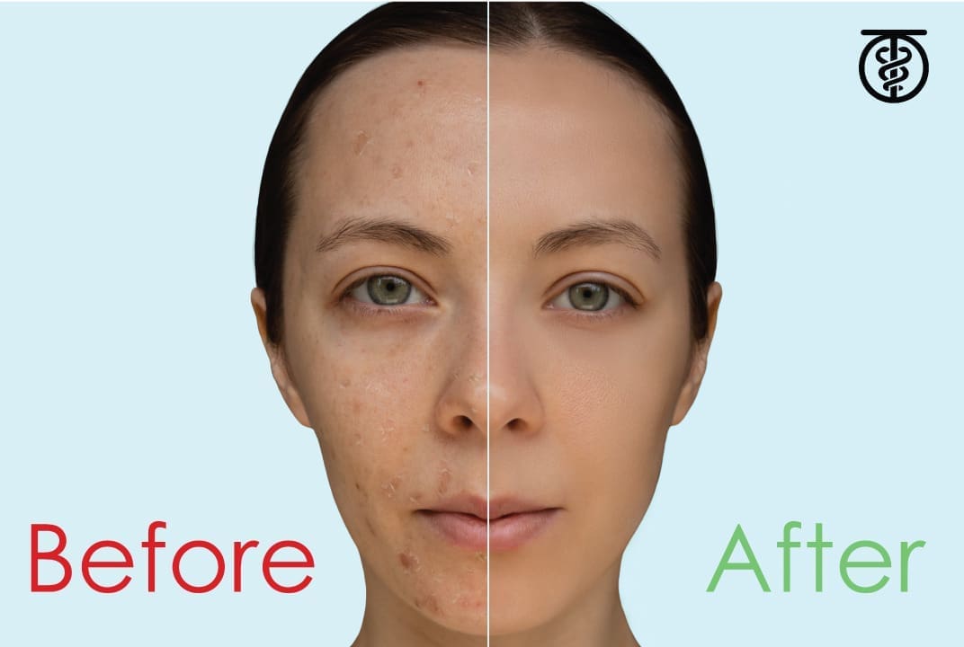 Is a chemical peel good for my skin?