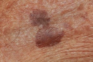 How to get rid of age spots, sun spots, liver spots